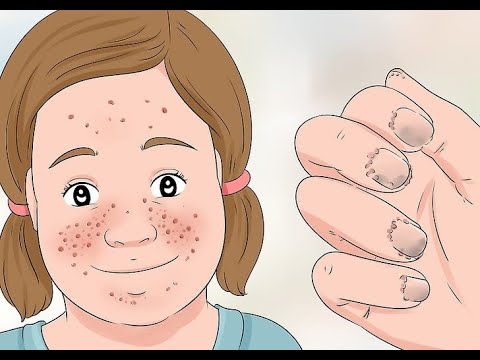 Видео: Информация о туберозном склерозе для родителей.