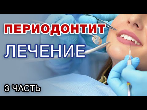 Видео: Лечение периодонтита - это риск? Можно ли вылечить периодонтит? / Часть 3
