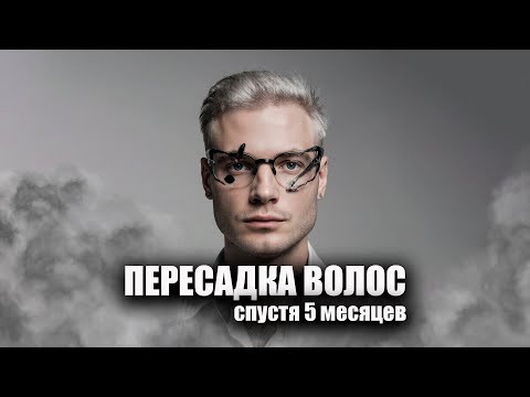 Видео: Пересадка волос спустя 5 месяцев / Клиника GG Med