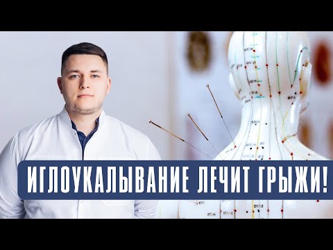 Видео: Иглоукалывание лечит грыжи! Подробно об иглорефлексотерапии.
