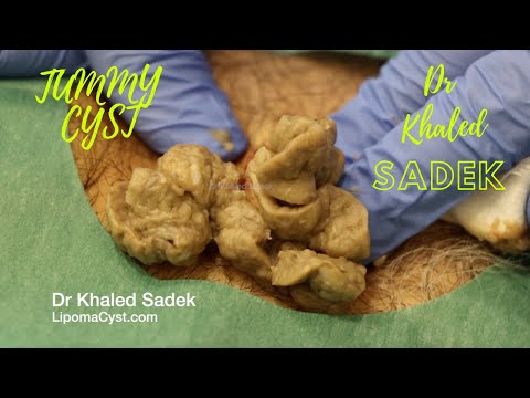 Видео: Огромная киста живота. Доктор Халед Садек. LipomaCyst.com
