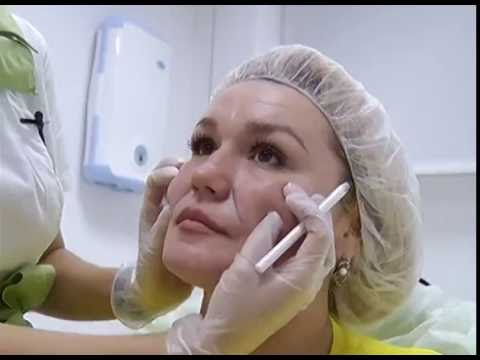 Видео: Коррекция морщин и контурная пластика 2