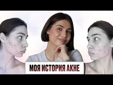 Видео: 4 года АКНЕ | ЧЕМ и КАК лечила? отвечаю на ВОПРОСЫ