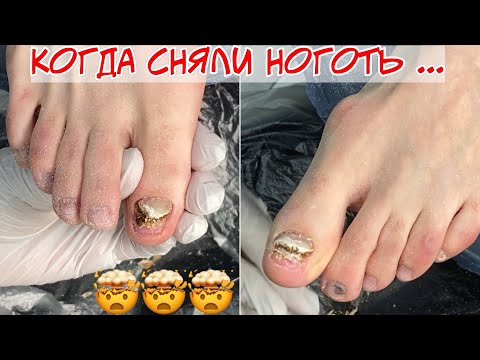 Видео: Онихолизис на ногах, отслоение ногтей на пальцах 😱 Почему пришлось снять ногти? 😵 nail vlog