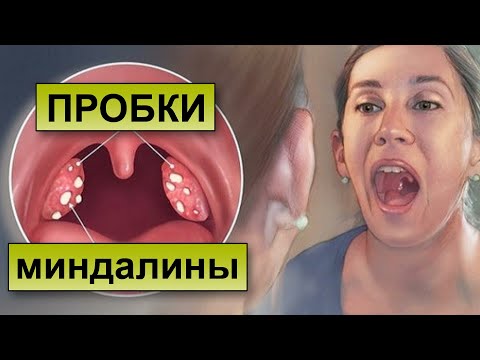 Видео: ПРОБКИ В ГОРЛЕ. Почему возникают пробки в миндалинах