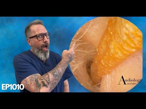 Видео: Удаление длинной кожной полоски из ушного канала (ОБЯЗАТЕЛЬНО К ПРОСМОТРУ) - EP1010