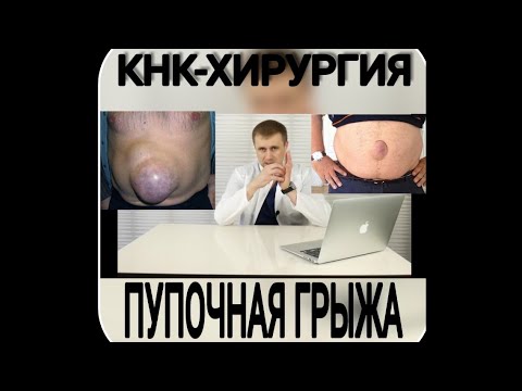 Видео: Пупочная грыжа