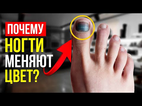 Видео: КАКИЕ ЕСТЬ БОЛЕЗНИ НОГТЕЙ? ДИСТРОФИЯ! Виды и Советы! (Подолог РЕКОМЕНДУЕТ!)
