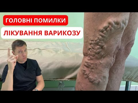 Видео: Як Правильно лікувати варикоз? Що треба знати кожному?