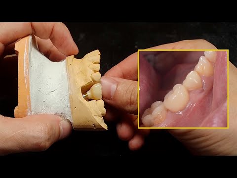 Видео: Изготовление коронки на импланте в зуботехнической лаборатории