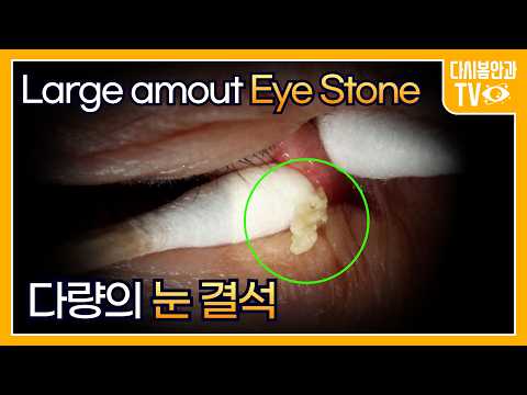 Видео: Удаление большого количества глазных камней
