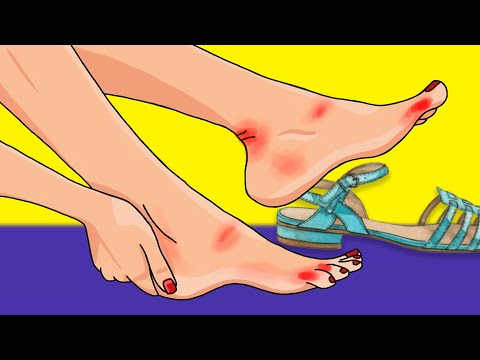 Видео: НАТИРАЕТ ЛЕТНЯЯ ОБУВЬ: как защитить ноги от мозолей?