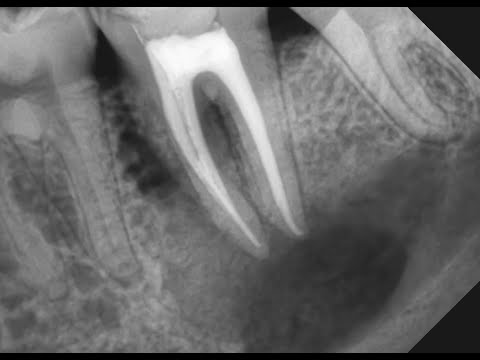 Видео: "Киста" зуба. Почему возникает киста после лечения каналов? Как лечить кисту? Киста зуба что это?