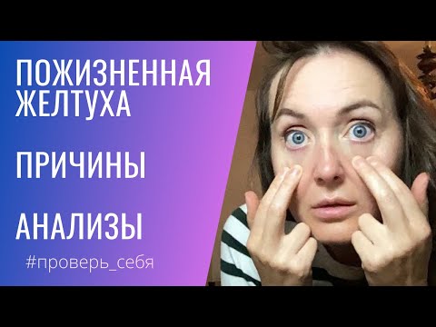 Видео: ЖЕЛТЫЕ белки глаз говорят что.... Синдром ЖИЛЬБЕРА. Высокий БИЛИРУБИН.