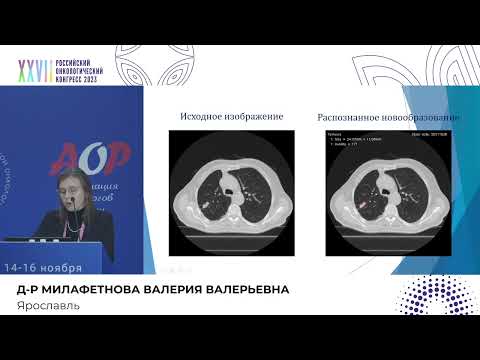 Видео: Компьютерный экспресс-метод оценки динамики ответа опухолевого процесса по RECIST критериям