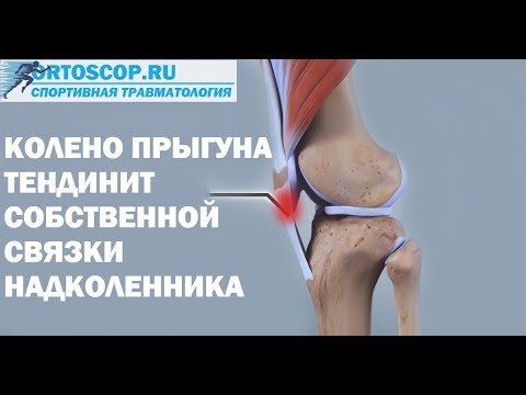 Видео: КОЛЕНО ПРЫГУНА.ТЕНДИНИТ СОБСТВЕННОЙ СВЯЗКИ НАДКОЛЕННИКА