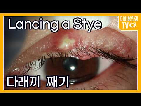 Видео: Дренирование ячменя