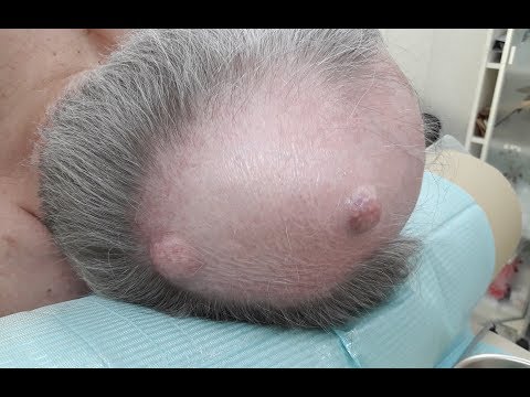 Видео: Удаление двух жировиков (атером) на голове