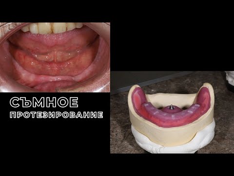 Видео: СЪМНОЕ ПРОТЕЗИРОВАНИЕ как поймать клапан