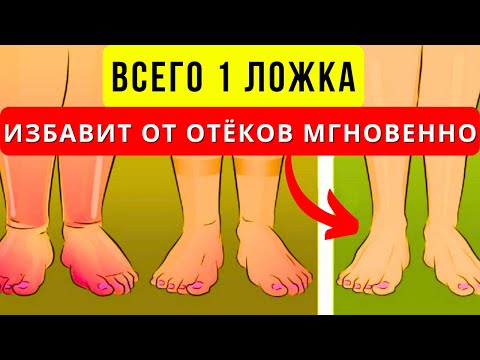 Видео: Как убрать отёки. Вам никто не говорил об этом. Отёки- это важно.