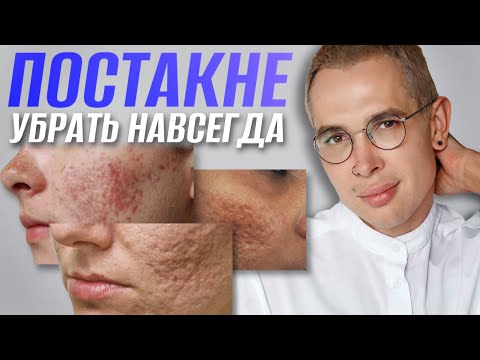 Видео: ПОСТАКНЕ как избавиться? Самый ПРАВИЛЬНЫЙ и ЭФФЕКТИВНЫЙ способ #постакне