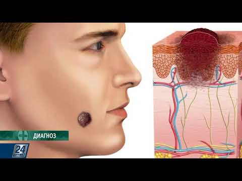 Видео: Тері қатерлі ісігінің кең таралған түрі қандай? І Диагноз
