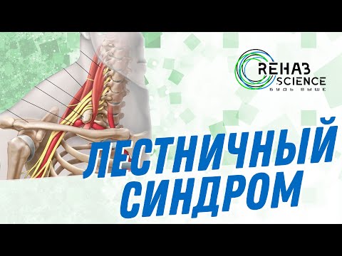 Видео: Лестничный синдром. Мягкая мануальная техника.