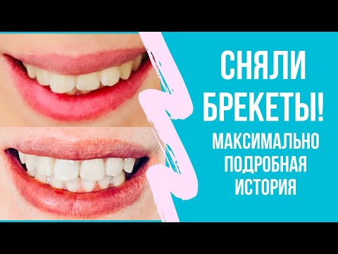 Видео: Брекеты: ДО / ПОСЛЕ во всех подробностях с промежуточными этапами