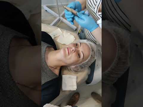 Видео: Как правильно работать Дермапеном при Куперозе