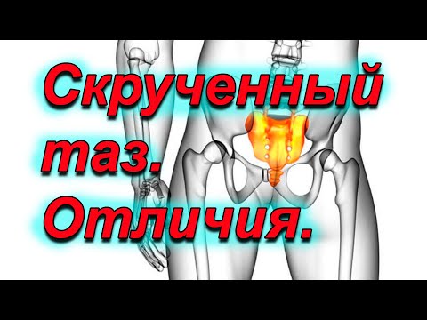 Видео: Скрученый таз. Как отличить от открытого таза.