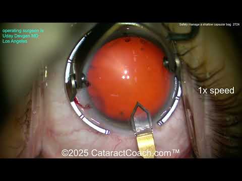 Видео: CataractCoach™ 2724: безопасное управление неглубоким капсульным мешком