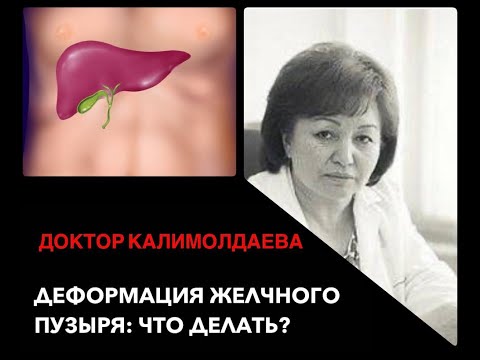 Видео: Деформация желчного пузыря: что делать?