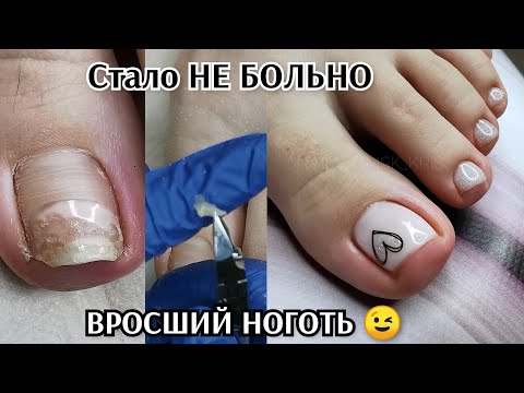 Видео: ВРОСШИЙ НОГОТЬ😉наконец-то НЕ БОЛЬНО💖нюдовый педикюр с слайдерами и блёстками🎊СЧАСТЛИВЫЙ КЛИЕНТ 💪