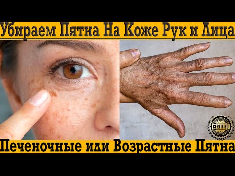 Видео: Печёночные или возрастные пятна на коже лица и рук! Как очистить и омолодить кожу !!!