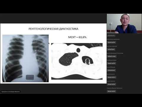Видео: Спонтанный пневмоторакс у детей - Митупов З.Б.