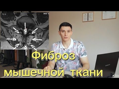 Видео: Фиброз мышечной ткани: причины и последствия. | Избавление от фиброза мышц: эффективные методы
