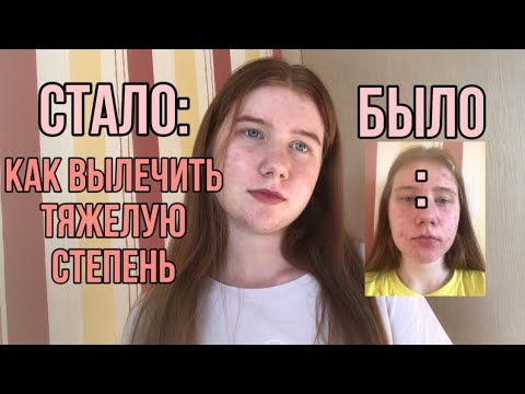 Видео: Как я вылечила кожу со сложной степенью розацеа и акне без ретиноидов