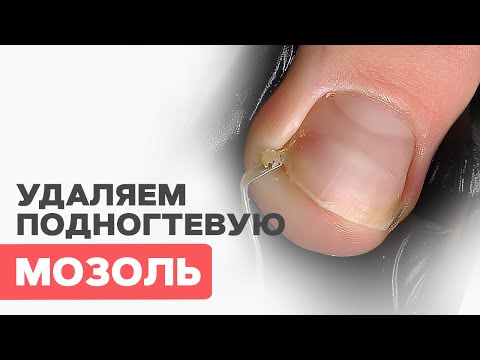 Видео: ПОДНОГТЕВАЯ мозоль | Как удалить?