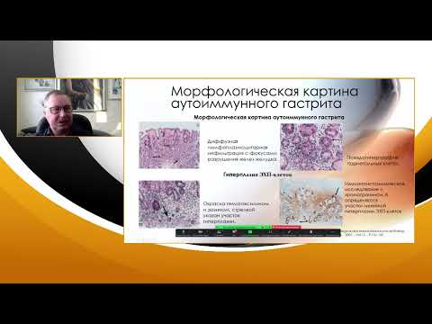 Видео: 4Назаров В.Е Аутоиммунный атрофич. гастрит. Скрининг, эндоскопическая и морфологическая диагностика