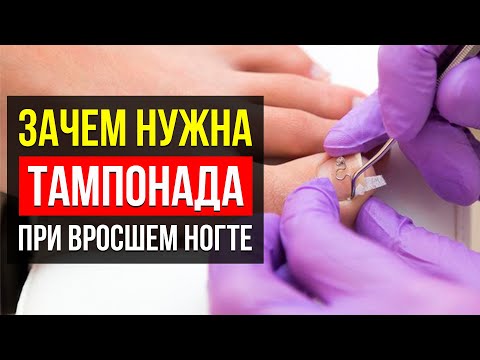 Видео: ТАМПОНАДА НОГТЕЙ. Что Это За Процедура? Какие Материалы используются?