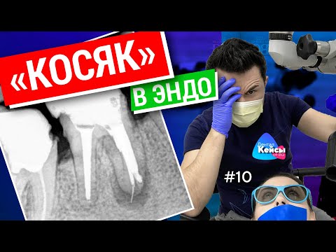 Видео: «Косяк» в эндо. Дентал Кейсы от BG #10