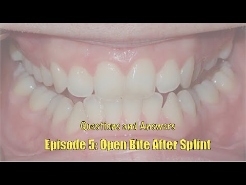 Видео: Вопрос 5: Могут ли шины стать причиной открытого прикуса?