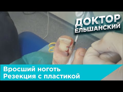 Видео: Вросший ноготь. Краевая резекция с пластикой по Шмидену.