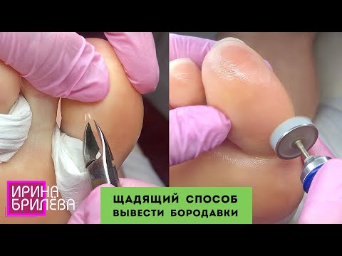 Видео: Как можно вывести мелкие бородавки (ЩАДЯЩИЙ СПОСОБ) 🌸 Подробный ПЕДИКЮР 🌸 Ирина Брилёва