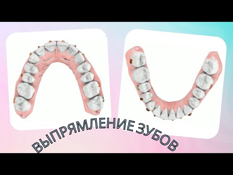 Видео: Выравнивание зубов элайнерами | мой опыт и советы