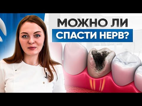 Видео: Сохраняем зубной нерв. Можно ли вылечить пульпит без удаления нерва?