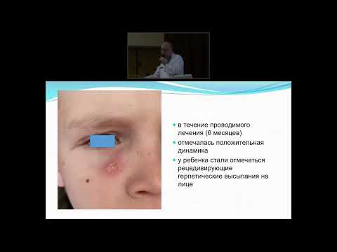 Видео: Таргетная терапия у ребёнка с тяжёлым атопическим дерматитом