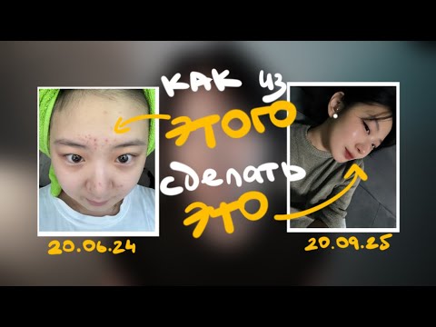 Видео: Ⳋ᧙ ⊹ МОЯ ИСТОРИЯ АКНЕ / как я ВЫЛЕЧИЛА ПРЫЩИ🥴 