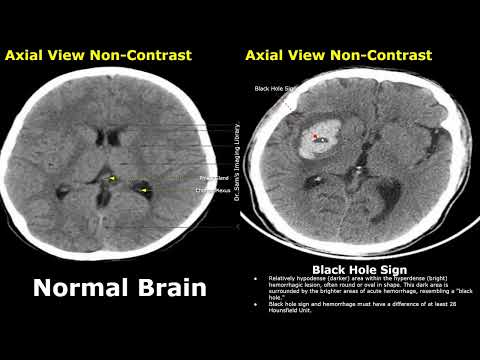 Видео: КТ головного мозга: нормальные изображения и изображения при геморрагическом инсульте | Признаки ...