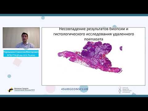 Видео: Чернышов Ранний рак прямой кишки